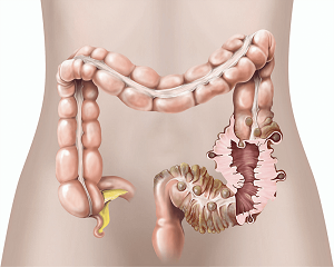 Diverticular Disease